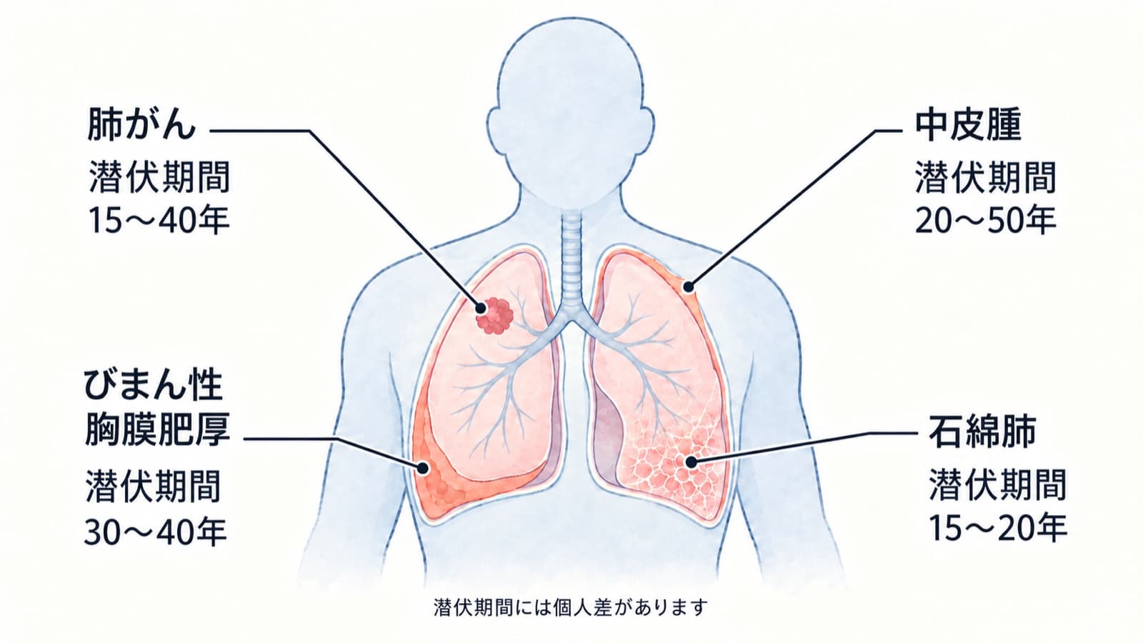 上半身の図に、肺がん・中皮腫・びまん性胸膜肥厚・石綿肺が起こる場所と、それぞれの潜伏期間の目安（肺がん15〜40年、中皮腫20〜50年、びまん性胸膜肥厚30〜40年、石綿肺15〜20年）を示した図