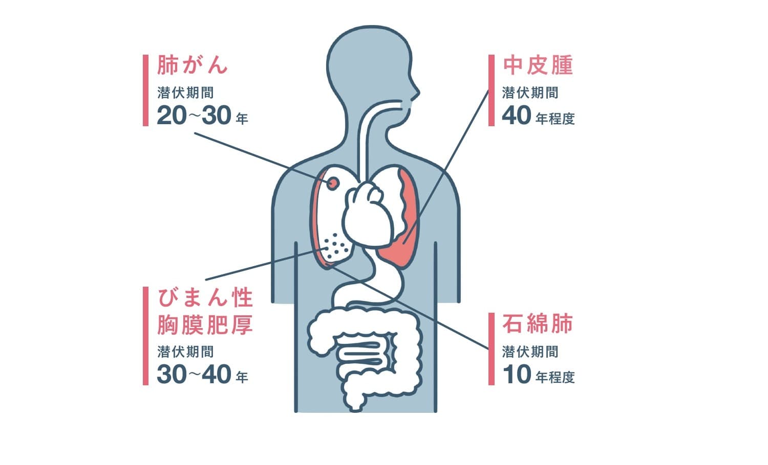 肺がん・中皮腫・びまん性胸膜肥厚・石綿肺の発症部位と潜伏期間の目安を示した人体図